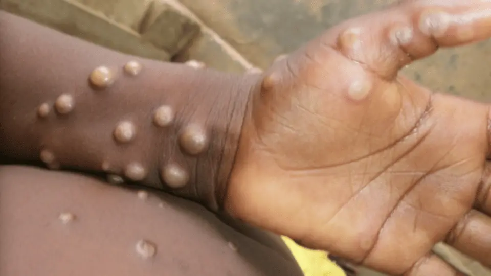 Close up image of monkeypox on persons hand and body