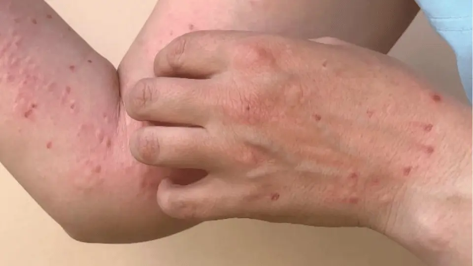 monkeypox rash on persons hands and arms